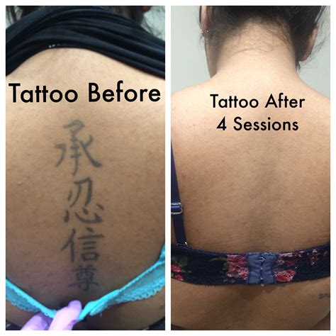 Tattoo Removal .
